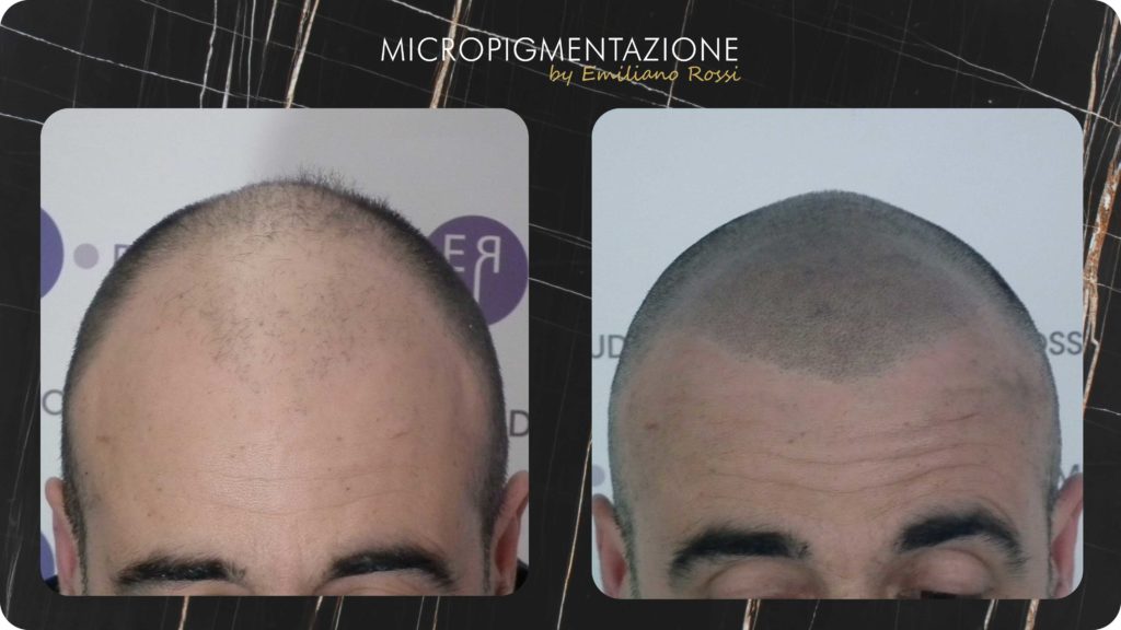 Effetto-Rasato-Emiliano-Rossi-Micropigmentazione